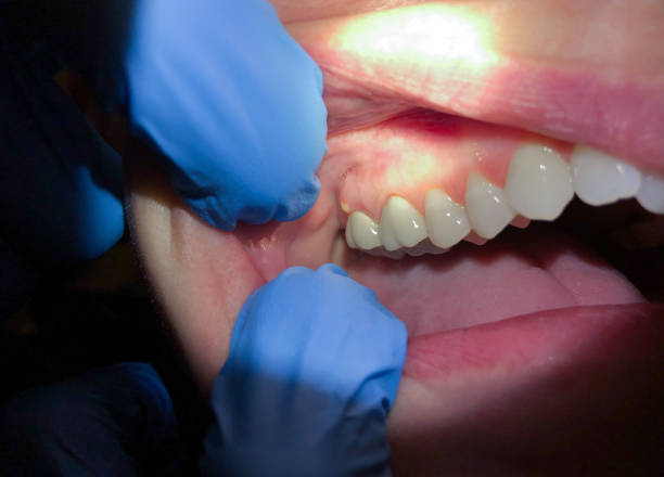 Best Emergency Tooth Extraction in Farmersville, CA