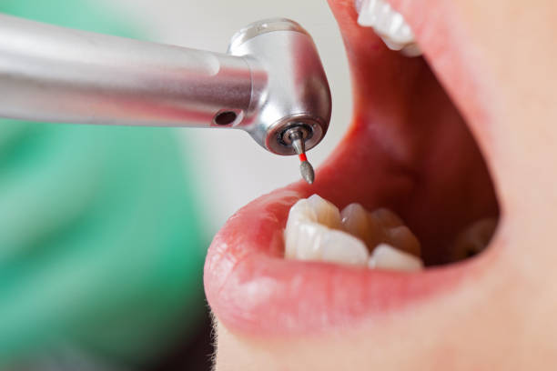 Best Emergency Tooth Extraction in Farmersville, CA